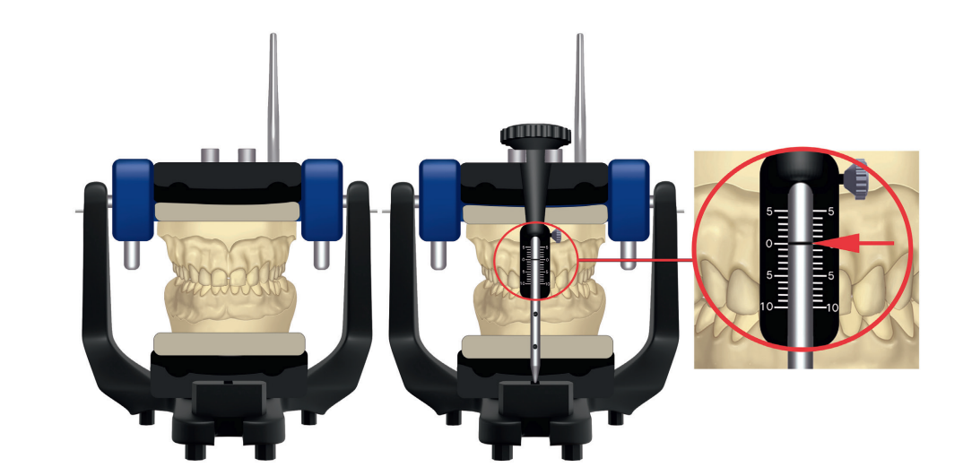 Dimensão vertical de oclusão - alterar ou manter?