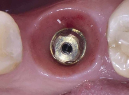 Pilares protéticos na Implantodontia