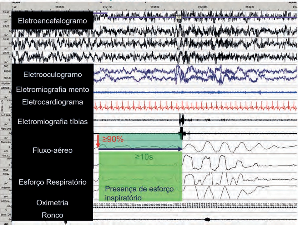 RRegistro-de-polissonografia-demonstrando-evento-de-apneia-obstrutiva-do-sono