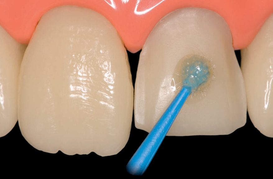 Adesão aos tecidos dentais