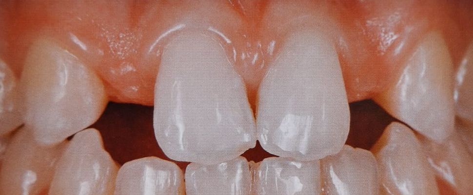 agenesia dentaria bilateral