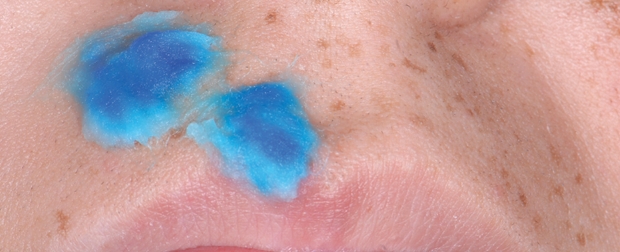 Aplicação do corante azul de metileno 0,01% por 5 minutos (tempo de pré-irradiação). Notar que a  superfície fica azulada.