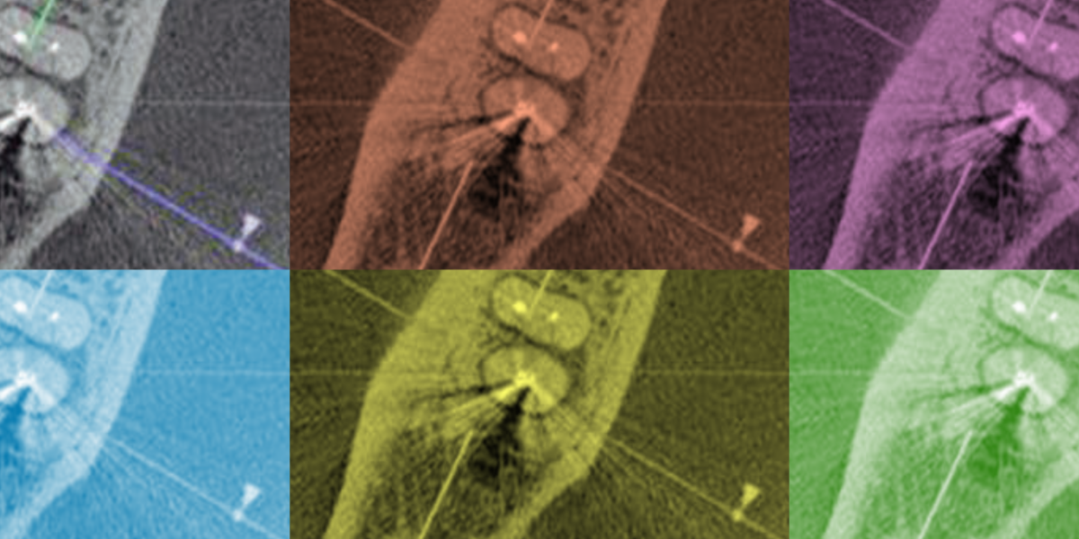 Imagem de tomografia computadorizada de feixe cônico no diagnóstico da Prótese e Endodontia