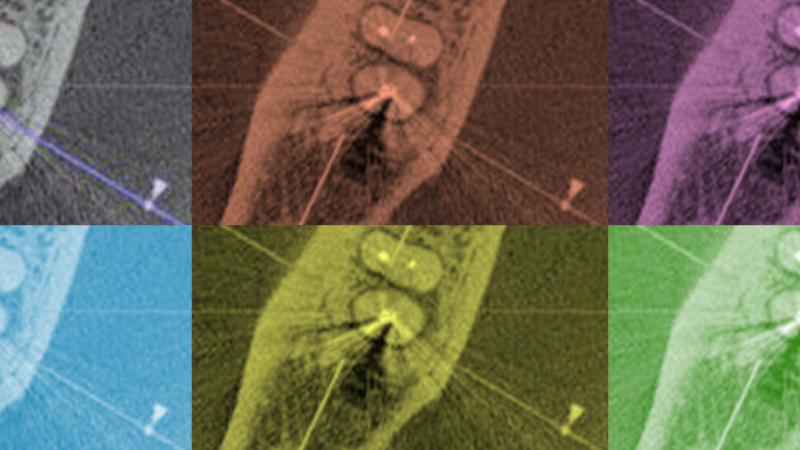 Imagem de tomografia computadorizada de feixe cônico no diagnóstico da Prótese e Endodontia