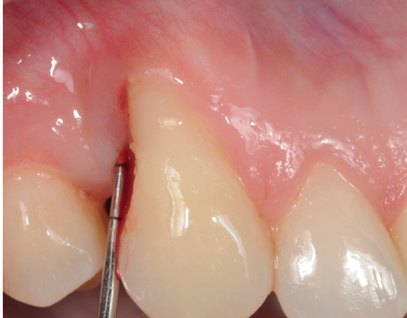 Exame de sondagem para monitoramento do risco de doença periodontal