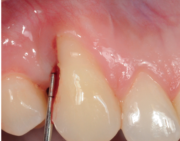 Exame de sondagem para monitoramento do risco de doença periodontal