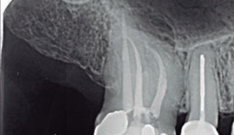 Lesões endo-periodontais e o diagnóstico radiográfico auxiliar