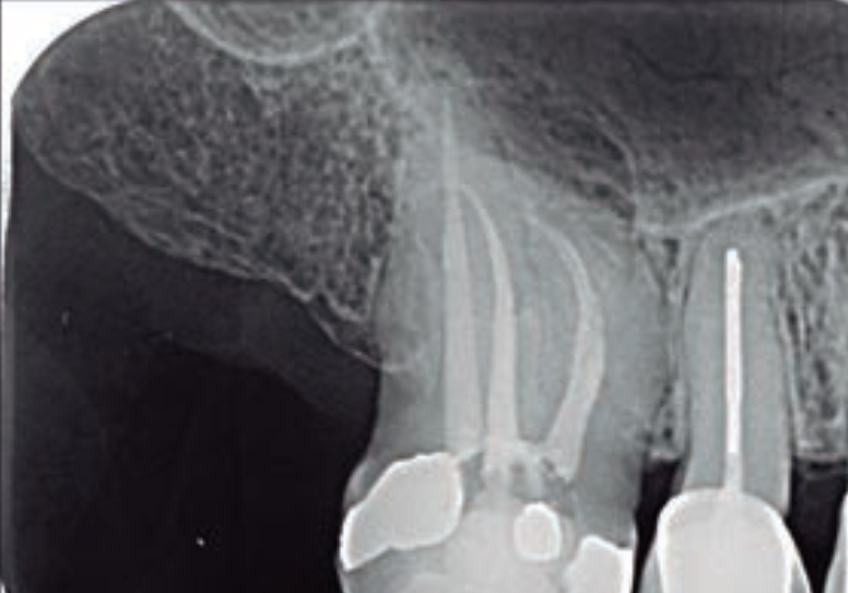 Lesões endo-periodontais e o diagnóstico radiográfico auxiliar