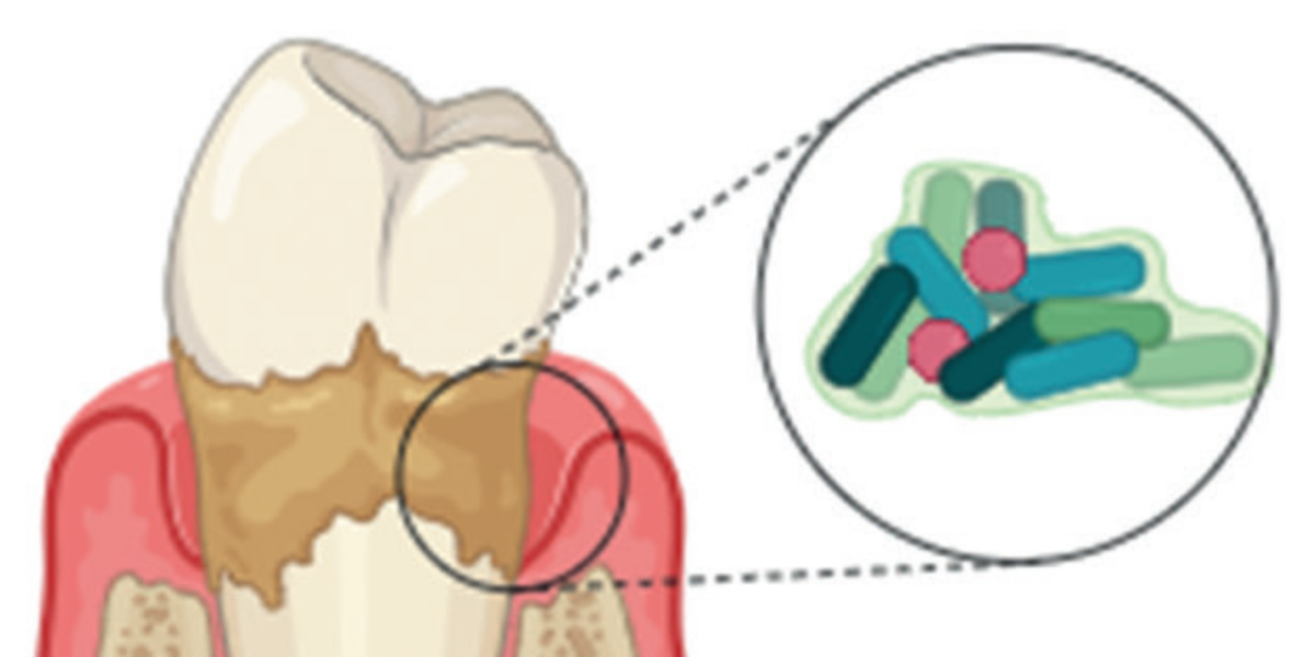 Lipídeos da P gingivalis provocam uma destruição silenciosa do osso periodontal