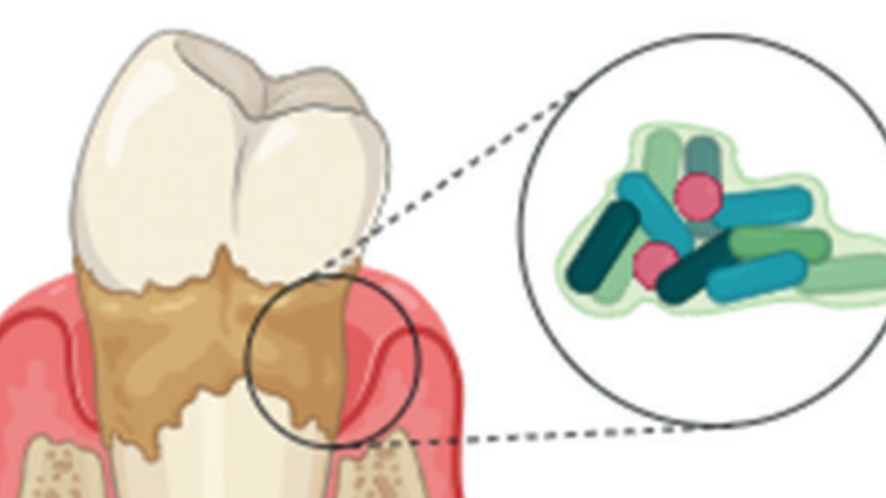 Lipídeos da P gingivalis provocam uma destruição silenciosa do osso periodontal