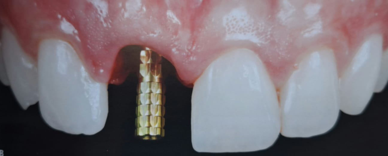 O canal angulado do parafuso: uma solução à estética dos implantes