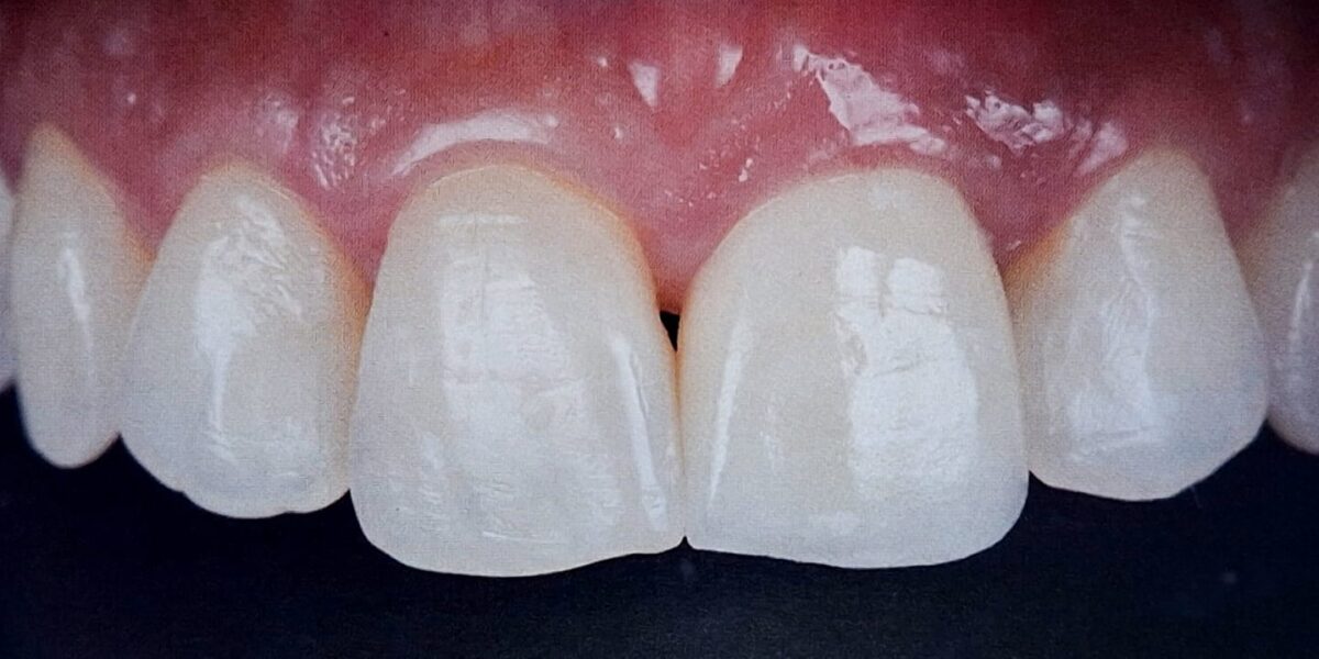 A estética na prótese unitária sobre implantes