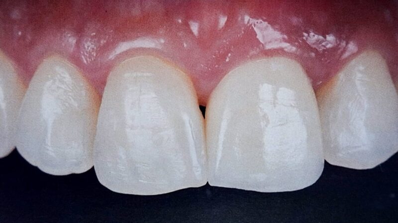 A estética na prótese unitária sobre implantes