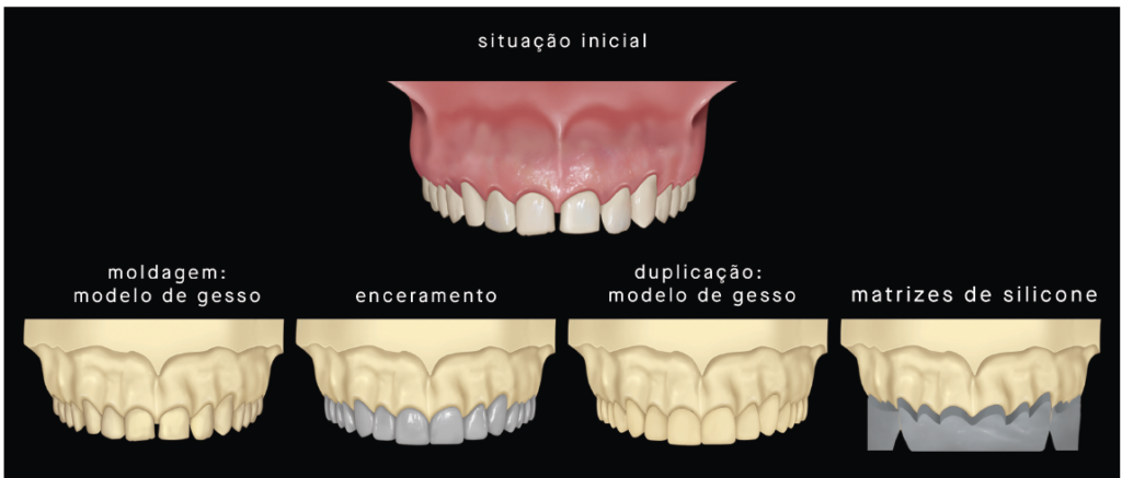 Técnica da dupla prensagem: produção do modelo de gesso e as matrizes de silicone.