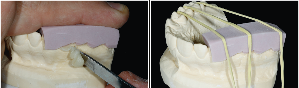 Remova os excessos de dentina e estabilize a matriz com tiras elásticas na técnica da dupla prensagem.