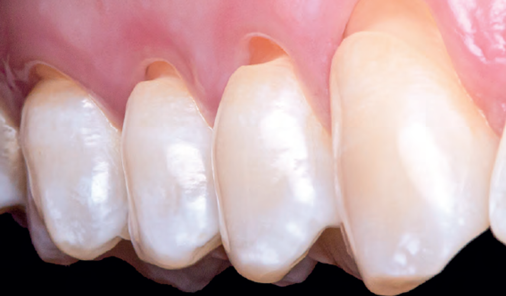 Lesão cervical não cariosa gerando hipersensibilidade dentinária