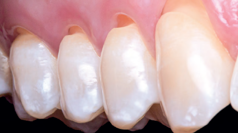 Lesão cervical não cariosa gerando hipersensibilidade dentinária