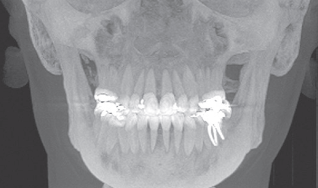 Tomografia computadorizada de feixe cônico com reconstrução 3D dos tecidos moles e duros
