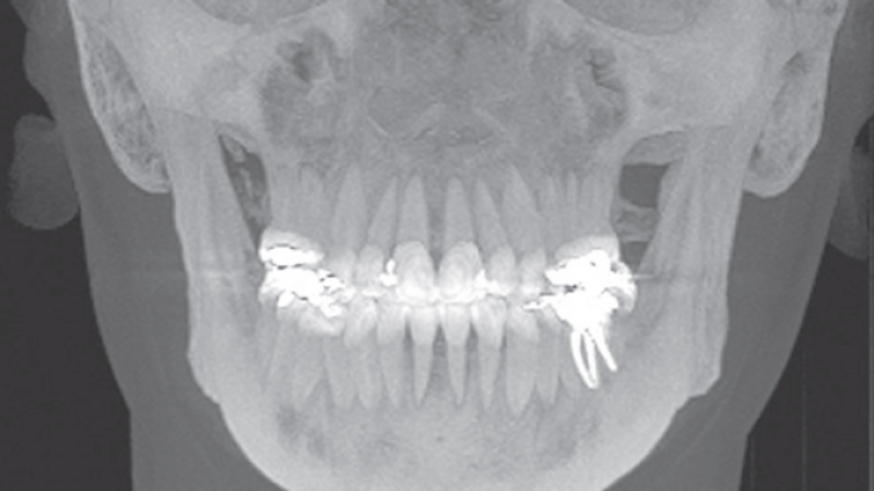 Tomografia computadorizada de feixe cônico com reconstrução 3D dos tecidos moles e duros