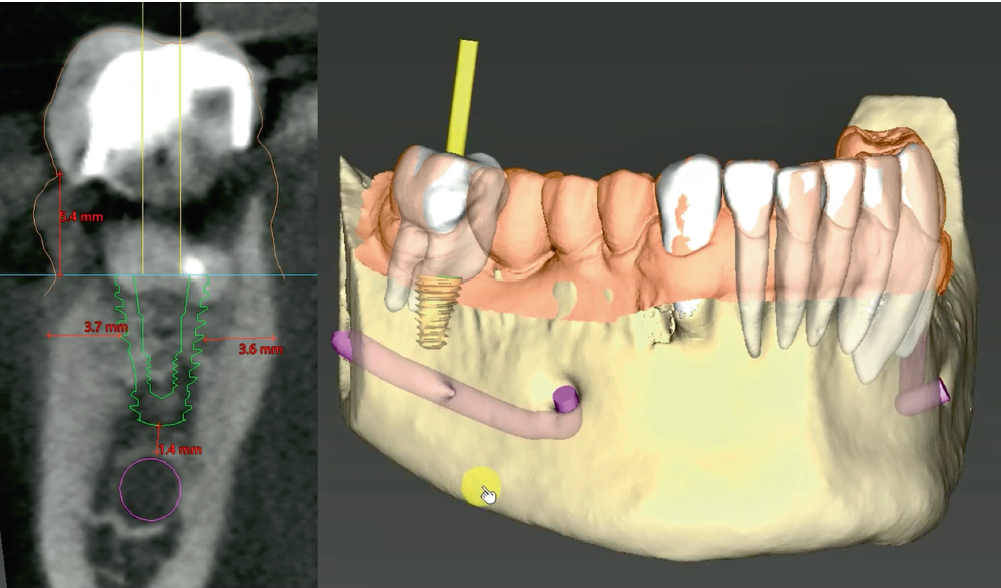Identificação e delineamento automatizados do canal mandibular e do forame mentual (cor rosa) com o software coDiagnostiX para planejamento virtual de implantes.