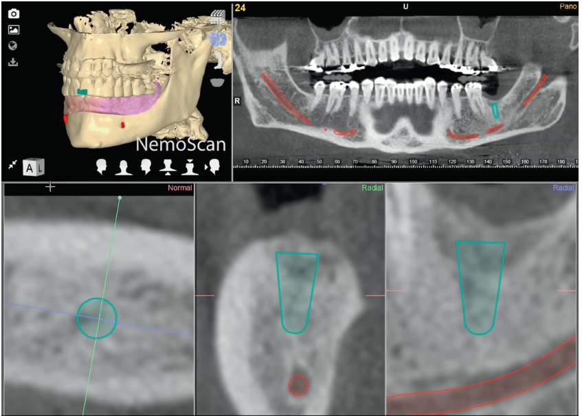 Identificação e o delineamento automatizados de ambos os canais mandibulares e forames mentuais com inteligência artificial na Odontologia.