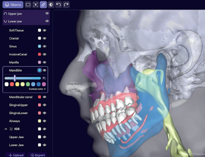 Segmentação automatizada das vias aéreas orofaríngea e nasofaríngea
(cor amarela), maxila (roxo) e mandíbula (azul) com o software Diagnocat.