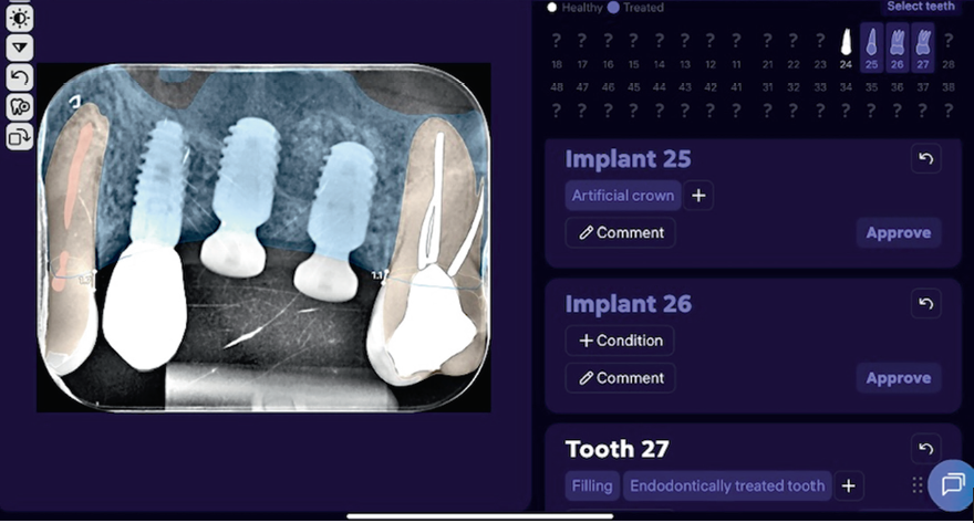 Observe a identificação correta de implantes, coroa protética, restauração e tratamento endodôntico usando a inteligência artificial na Odontologia.