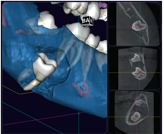 Vista lingual do modelo 3D de IA da TCFC com expansão e o
adelgaçamento da cortical lingual da lesão bucal.