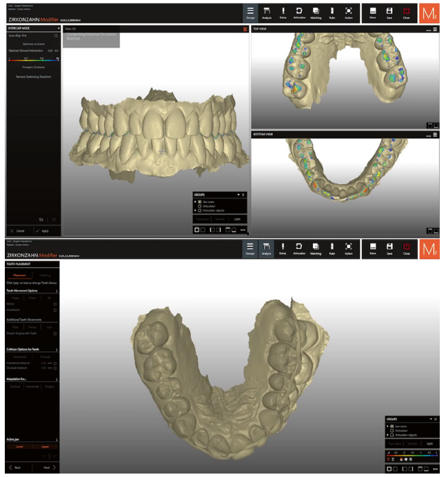 Uso do botão "otimizar oclusão" que gera a ausência de sobreposições e o registro oclusal adequado.