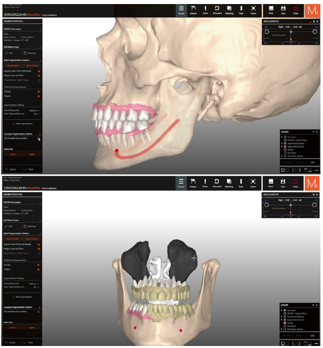 Dentes e estruturas anatômicas segmentadas: canal mandibular (cor vermelha) e os seios maxilares (cor preta). Agora, cada dente e estrutura pode ser exportada individualmente. Assim, a IA constrói o paciente virtual.