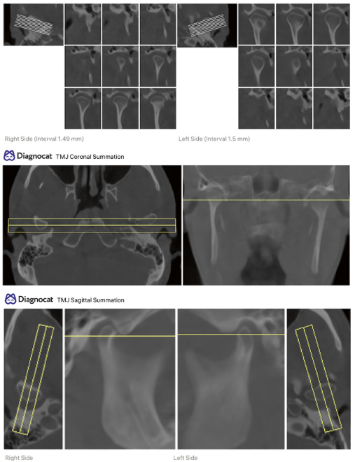 Análise da articulação temporomandibular com o software Diagnocat.