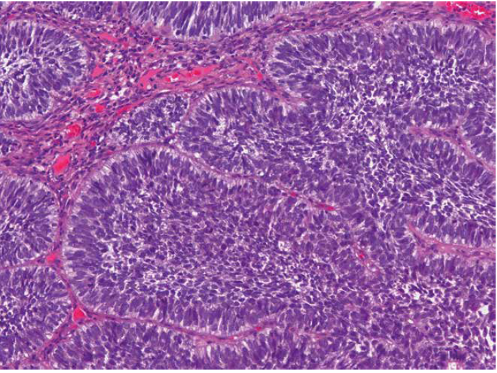 Tumores odontogênicos - carcinoma ameloblástico. Visão geral mostrando os pseudofolículos e grande celularidade do tumor.