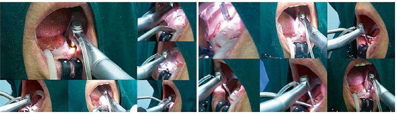 Preparação do robô paras as osteotomias e colocação dos implantes dentários.