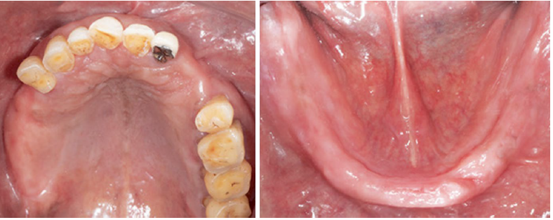 Situação inicial do caso clínico: paciente de 66 anos de idade, com perda dentária mandibular total dois anos atrás e desconforto no uso de uma prótese parcial removível.