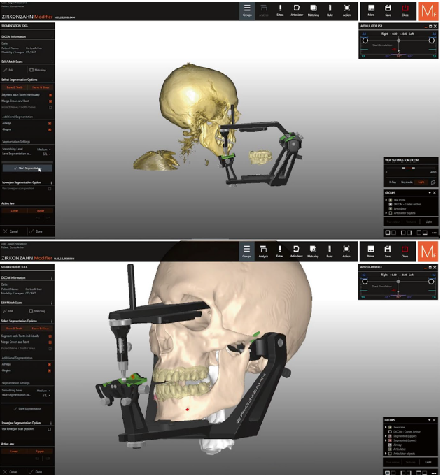 Antes e depois de ativar o botão que alinha TCFC e os escaneamentos intraorais no paciente virtual.
