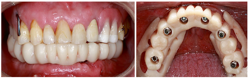 A prótese imediata capturada na arcada mandibular em oclusão com a prótese removível na arcada maxilar: a inteligência artificial na implantodontia usada com sucesso.