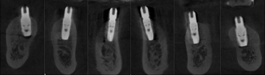 Análise pós-operatória imediata: cortes sagitais da TCFC mostrando o posicionamento dos implantes dentários.