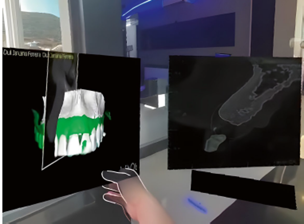 Manipulação em realidade virtual dos modelos digitais e cortes tomográficos para analise precisa do planejamento dos implantes