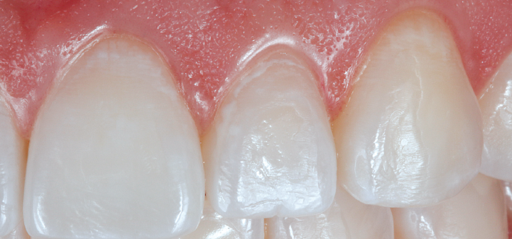Aspecto inicial de uma paciente com dentes sensíveis e refluxo gástrico.