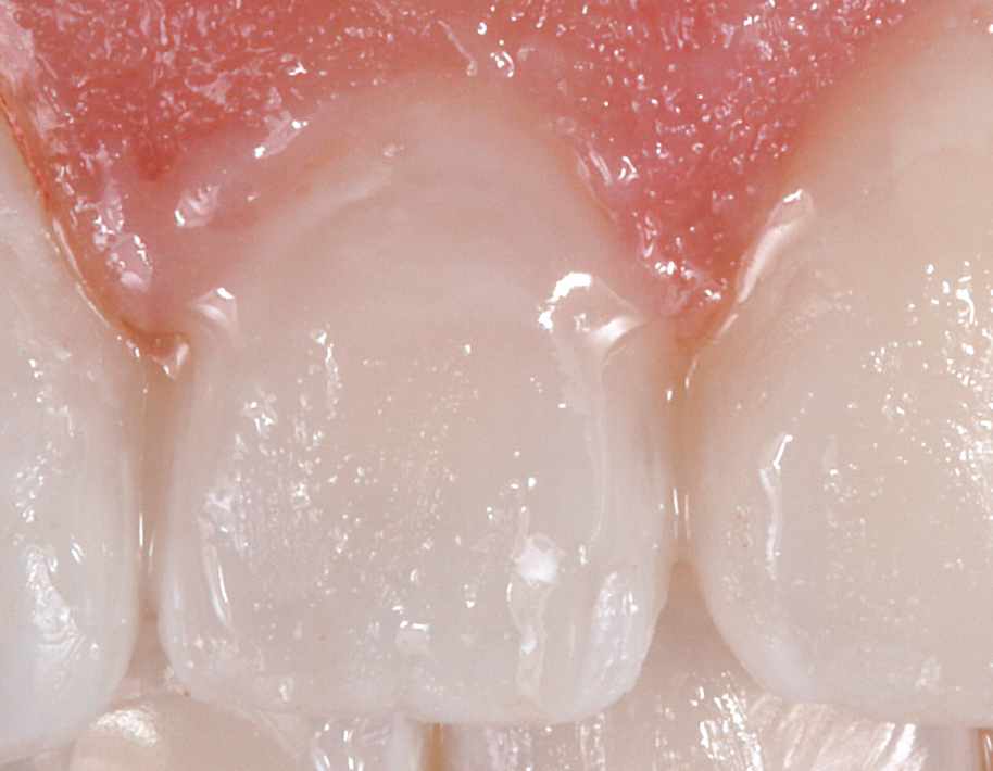 O paciente é orientado a não ingerir nenhum alimento, não “passar a língua” nem higienizar os dentes (fio dental e escovação) durante 4 horas. O paciente relata ausência de dor (EVA = 0) com estímulo de jato de ar.