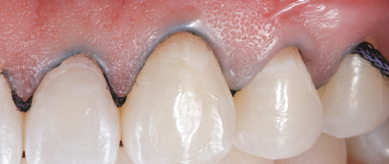 Fio afastador inserido nos dentes sensíveis 22, 23 e 24, realizando afastamento para aplicação do gel dessensibilizante.