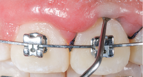 Isolamento relativo da região com uso de algodão, gaze, afastador labial e inserção do fio afastador. O aparelho ortodôntico fixo está em posição.
