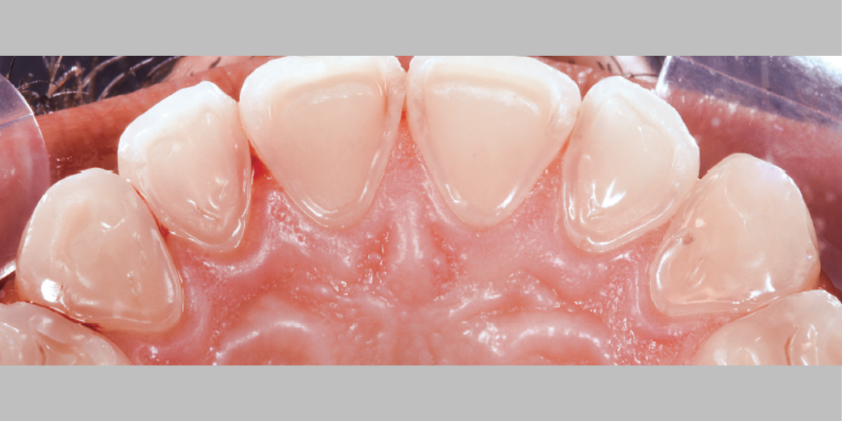 Dentes sensíveis e refluxo gástrico