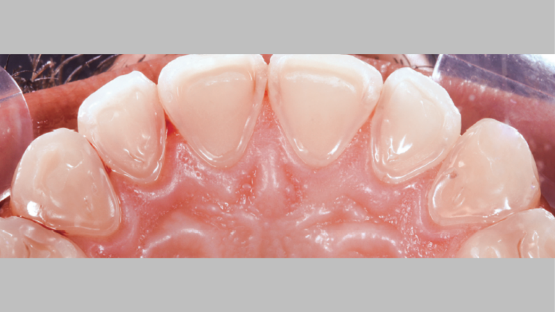 Dentes sensíveis e refluxo gástrico