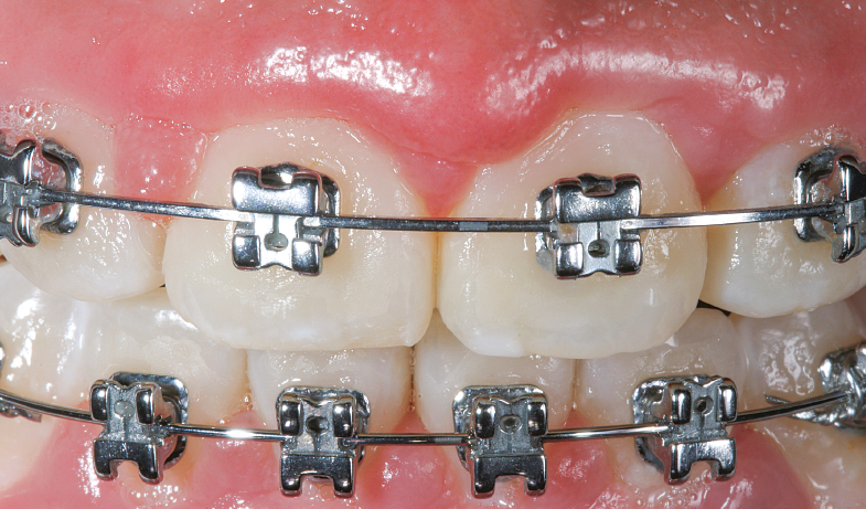 Aspecto inicial dos incisivos da paciente com aparelho ortodôntico fixo e dente sensível. A dieta ácida foi identificada.