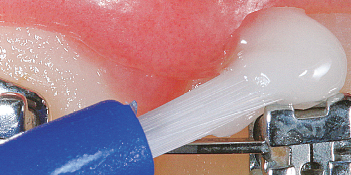 Aparelho ortodôntico e dente sensível