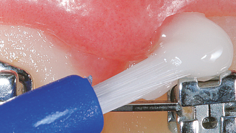 Aparelho ortodôntico e dente sensível