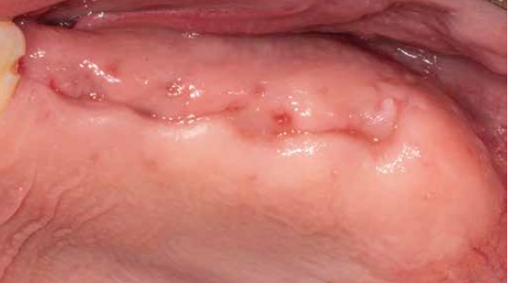 Duas semanas após a cirurgia: incisão intacta e o local com boa cicatrização.