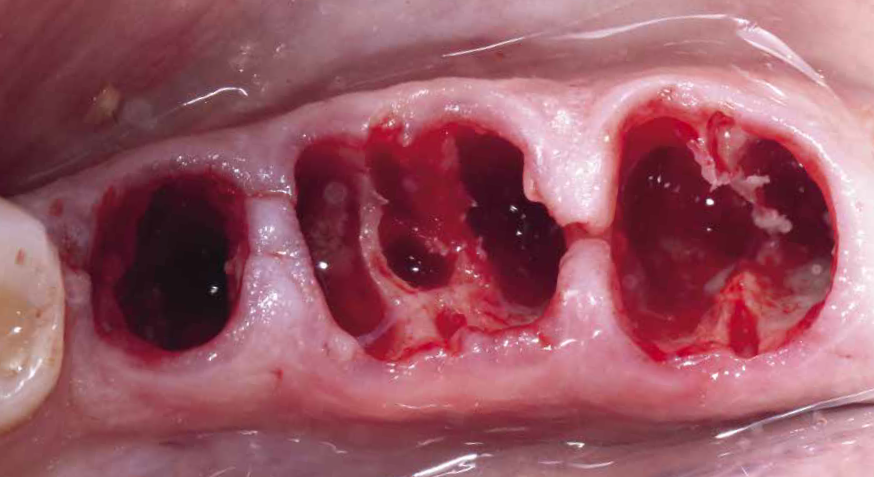 Perfurações para implantes seguindo o alvéolo do pré-molar e nos septos dos molares.