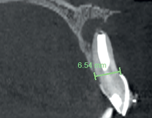 A dimensão mais cervical do alvéolo de extração: 6,5 mm.